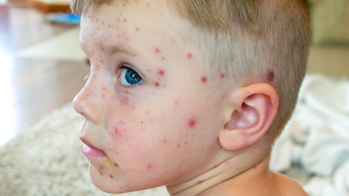 Hygienička: Covid neštovice utlumil, letos může být rekordní počet nakažených